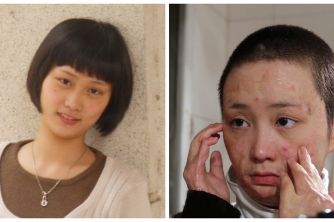 Le combat d&rsquo;une jeune Chinoise défigurée par un amoureux jaloux