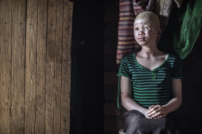 La poursuite et le meurtre rituel des albinos augmentent au Malawi