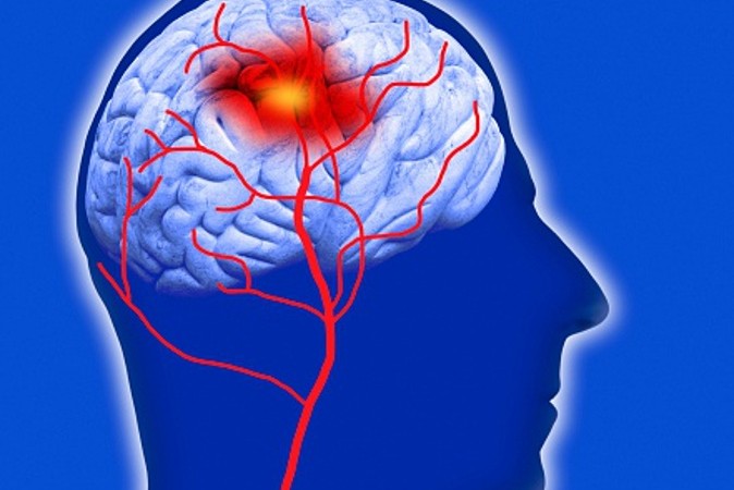 91% des AVC pourraient être évités selon une étude récente