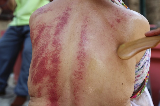 Une technique ancienne pour dissiper la douleur