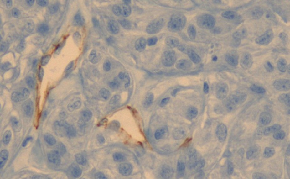 Des nanoparticules d’or pour détruire les tumeurs