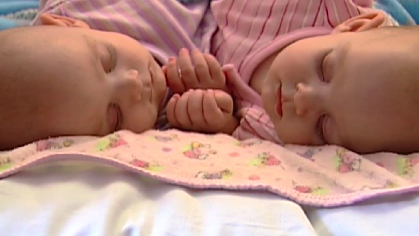 Ces jumelles siamoises reliées par la poitrine ont été séparées lors d&rsquo;une opération de 12 heures – voici à quoi elles ressemblent 10 ans plus tard