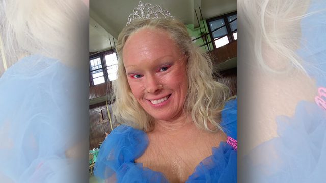 Une femme harcelée pour son problème de peau n&rsquo;a pas laissé les injures l’empêcher de devenir une reine de beauté