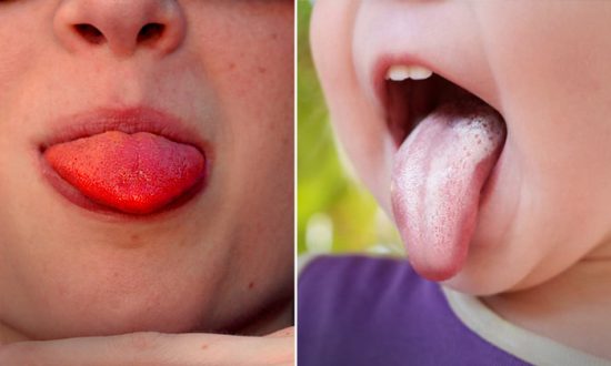 13 choses que votre langue révèle au sujet de votre santé – Une langue rouge vif signifie que vous devriez consulter un médecin