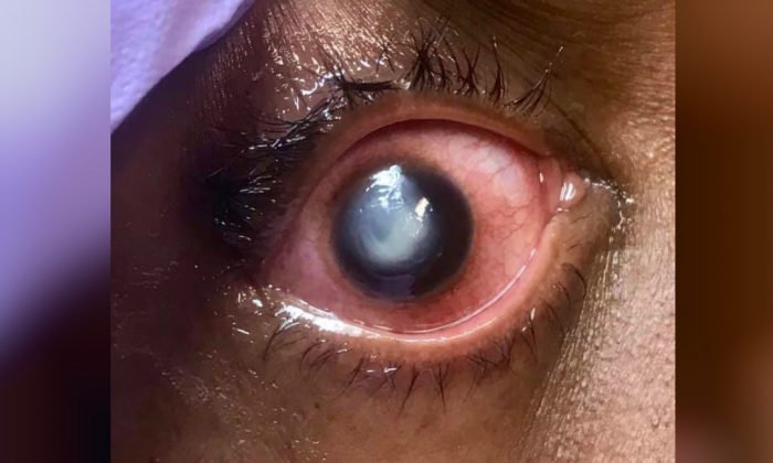 Un ophtalmologue partage des photos explicites sur les risques à dormir avec des lentilles de contact