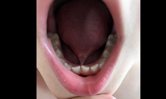 Un garçon que l’on croyait incapable de s’exprimer, parle après que le dentiste a trouvé quelque qui le gênait dans sa bouche