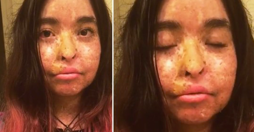 Les taches de rousseur d’une fille intimidée sont si extrêmes qu’elle ne peut sortir que la nuit