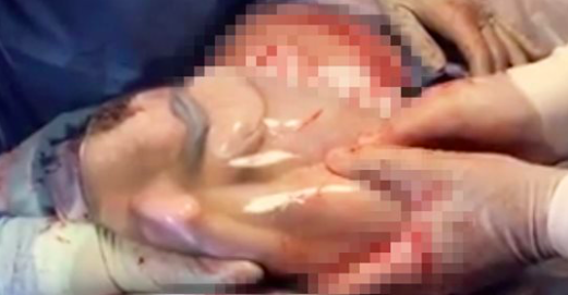 Un médecin donne naissance à de rares triplés et reste silencieux quand le troisième bébé émerge du ventre de sa mère