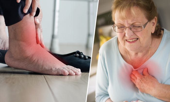 5 affections alarmantes liées aux pieds enflés. Le no 5 est l’insuffisance cardiaque