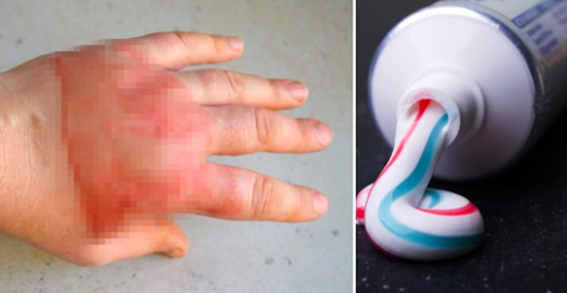 N’utilisez pas de dentifrice sur les brûlures: un médecin met en garde au sujet des remèdes maison après que l’expérience d’une femme a mal tourné