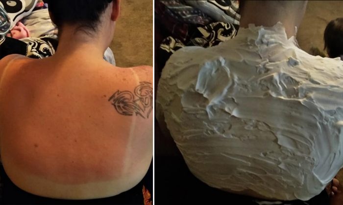 Un conseil de maman pour traiter les coups de soleil devient viral, les dermatologues disent que ça marche vraiment