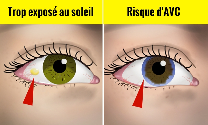 Voici 10 signes et symptômes oculaires que vos yeux révèlent sur votre santé