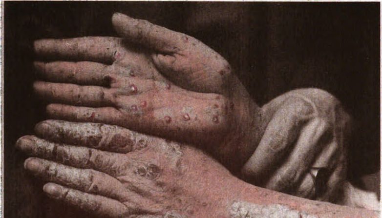 Un enfant atteint de psoriasis généralisé affirme qu&rsquo;il «préfère mourir» si on ne trouve pas de traitement