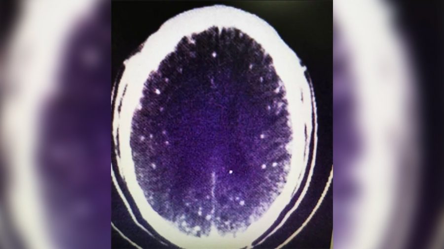 Un homme s&rsquo;effondre après avoir mangé une fondue chinoise – son cerveau était infesté de vers