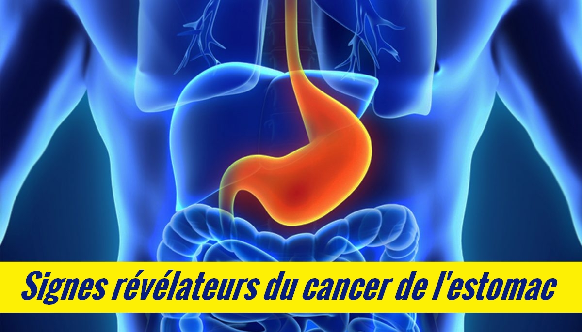 8 signes d&rsquo;avertissement du cancer de l&rsquo;estomac que vous ne devriez pas ignorer