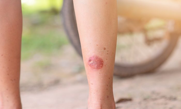 Un garçon de 10 ans meurt 9 jours après l&rsquo;apparition d&rsquo;une marque étrange sur sa jambe pendant un match de football