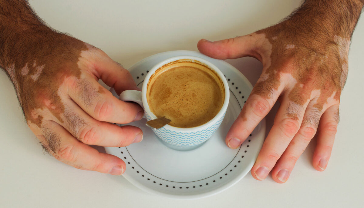 Intimidé à l&rsquo;école et atteint du vitiligo, cet homme décroche une carrière de mannequin après la publication d&rsquo;un selfie