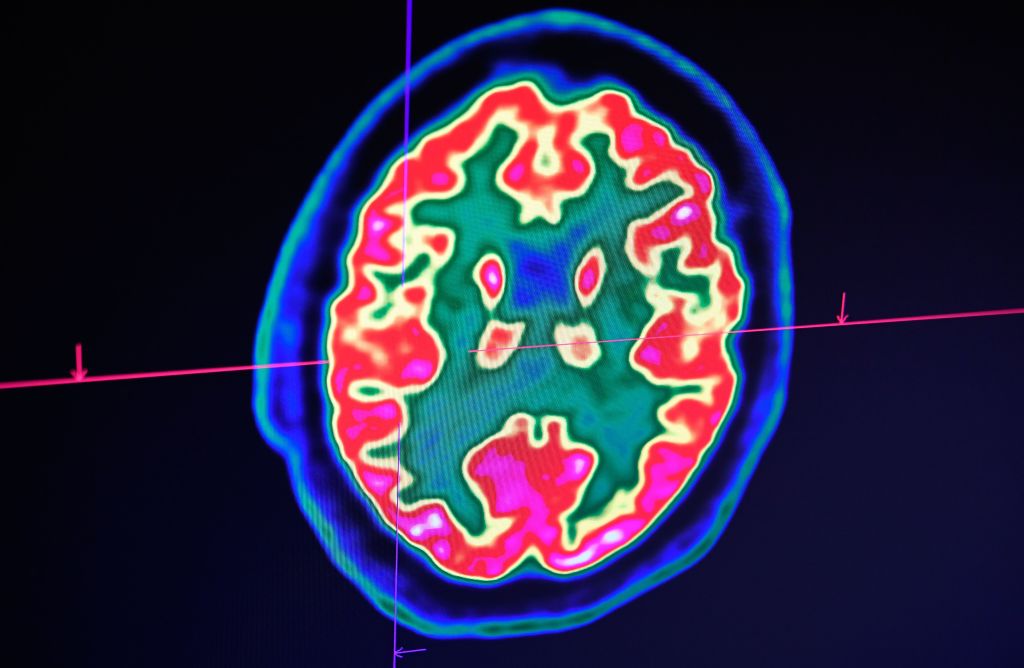 Le coronavirus semble aussi affecter le cerveau avec des pertes de mémoire et de la confusion