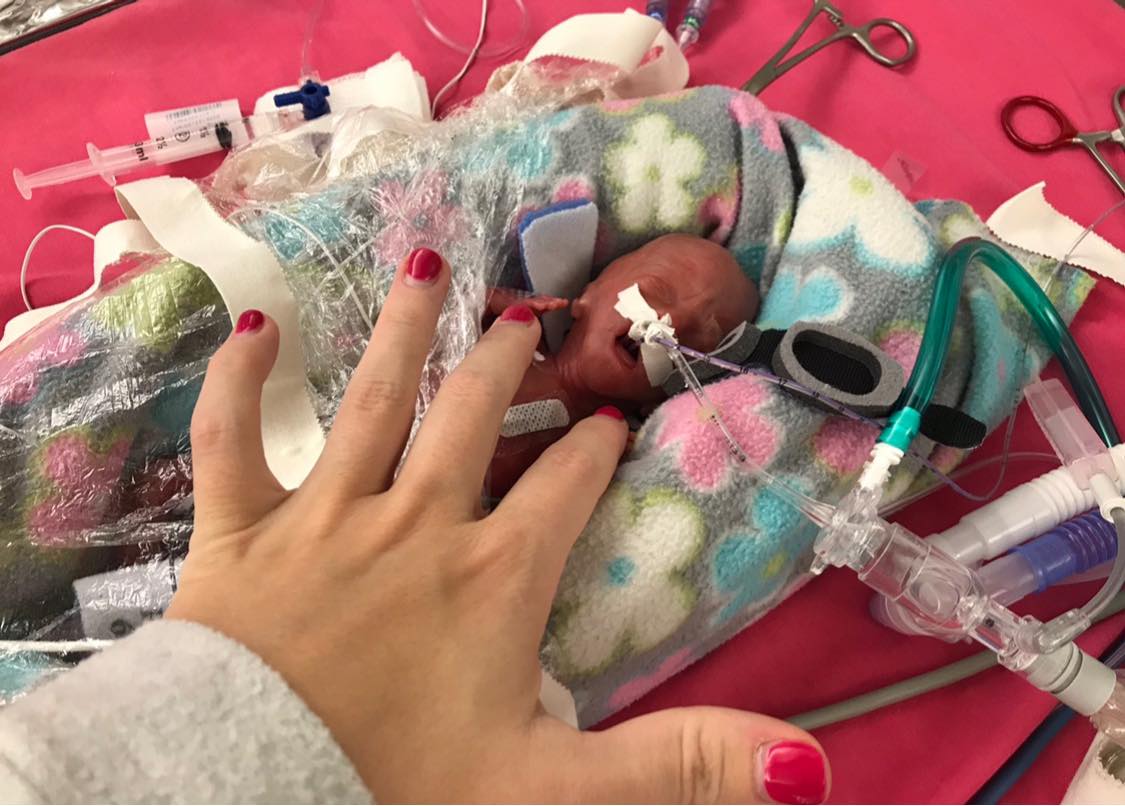 Les « jumelles les plus prématurées au monde » fêtent leur deuxième anniversaire après avoir battu tous les records