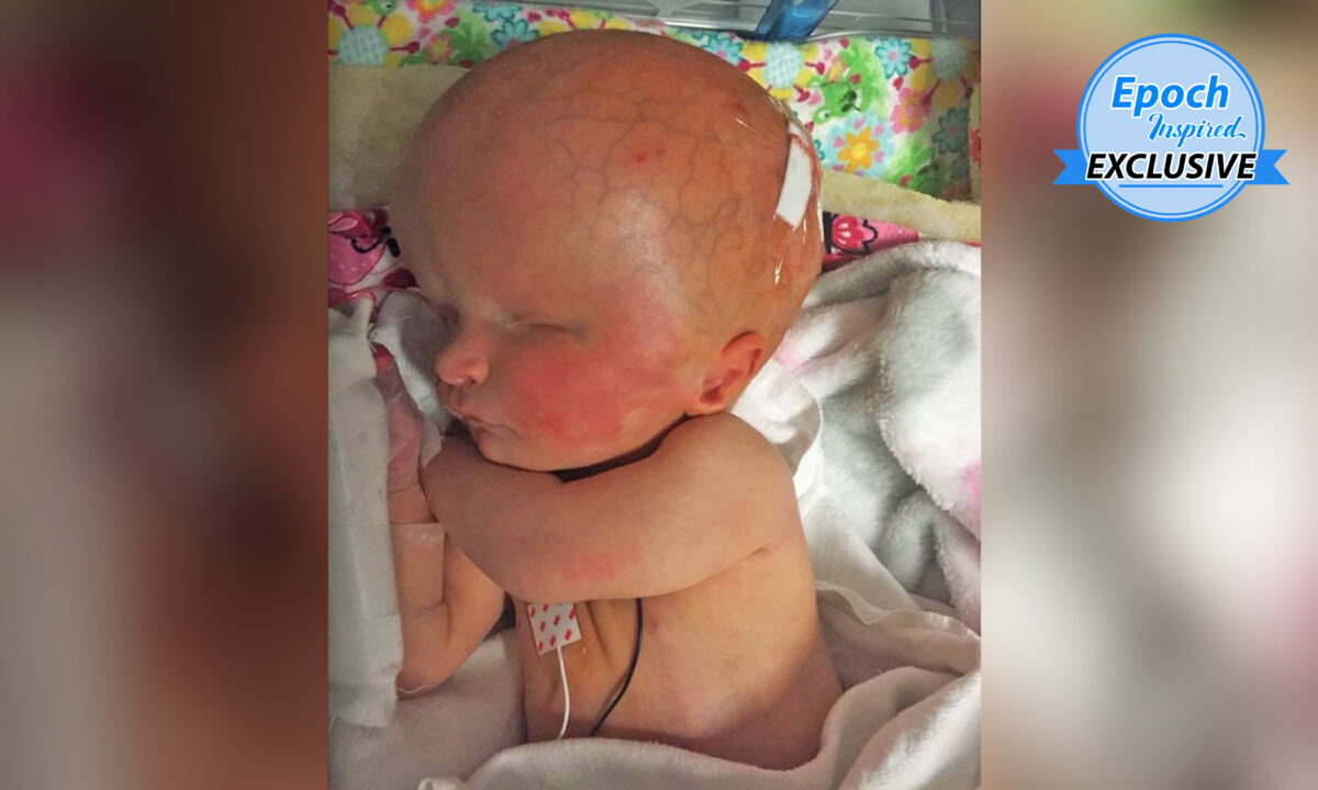 Une petite fille née avec les deux tiers de son cerveau manquants et sans yeux défie les prédictions des médecins