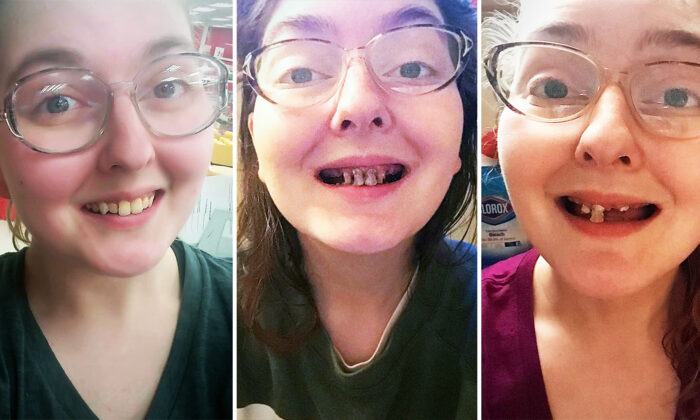 Une femme partage des photos effrayantes de caries dentaires survenues après trois ans de consommation de boissons gazeuses et d&rsquo;absence de brossage