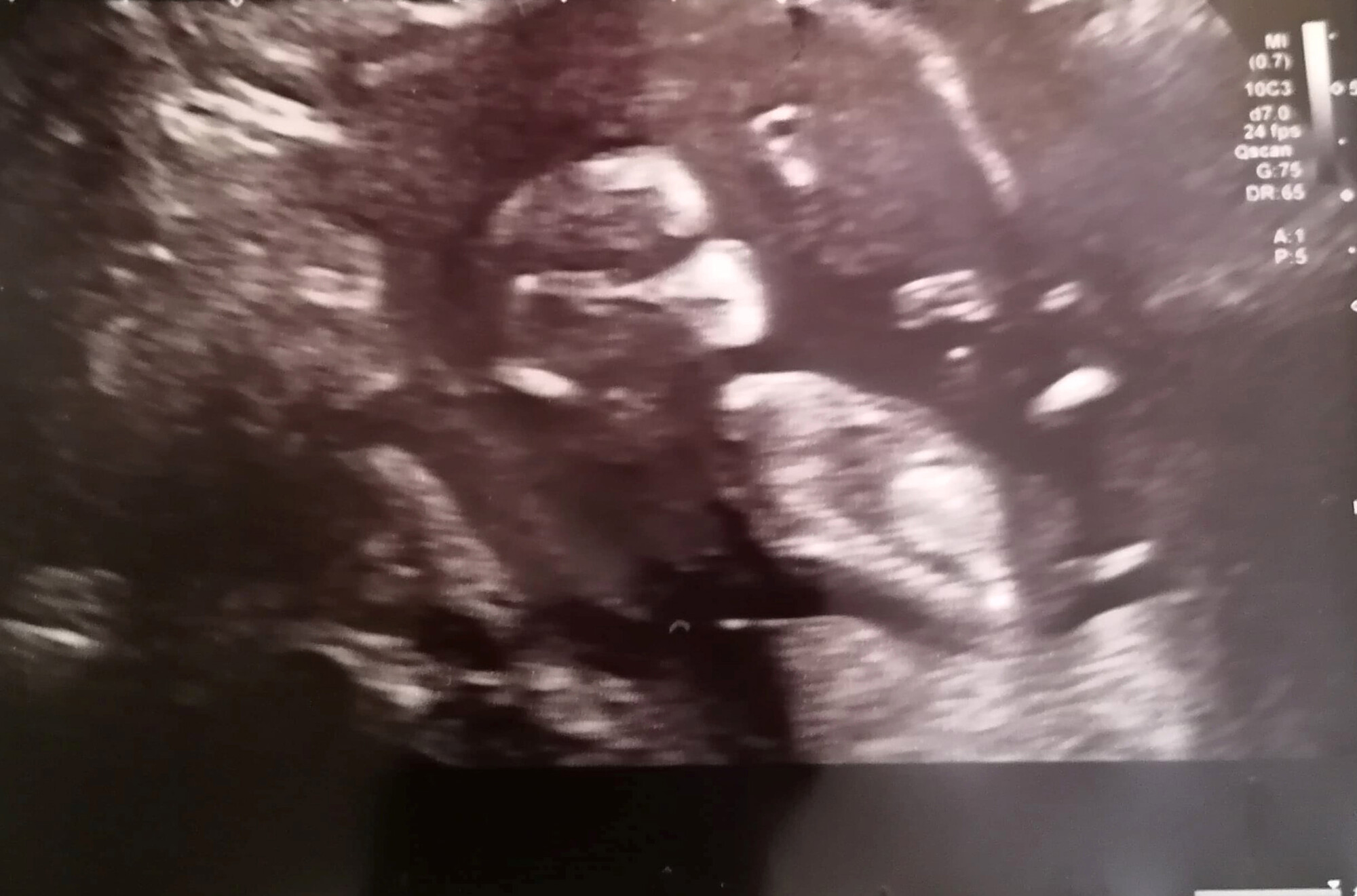 Une échographie de grossesse donne l’impression que le bébé porte un masque – l’examen de la maman est positif au COVID