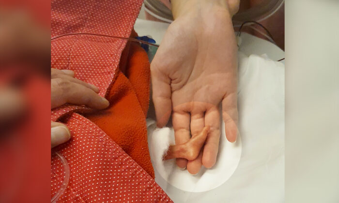 Un bébé prématuré d&rsquo;un demi-kilo, avec des pieds de la moitié de la taille de l&rsquo;index de sa mère, défie ses chances de survie