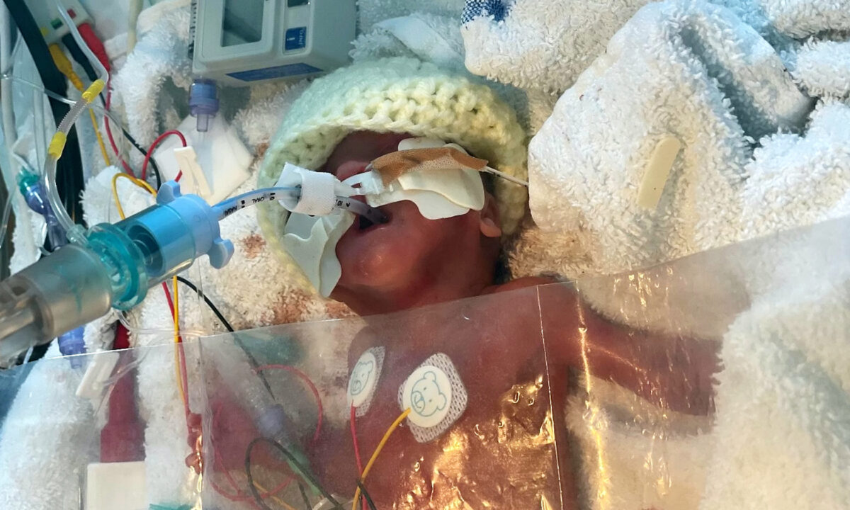 Un bébé prématuré de 17 semaines survit après que ses parents ont refusé à deux reprises de débrancher son respirateur artificiel