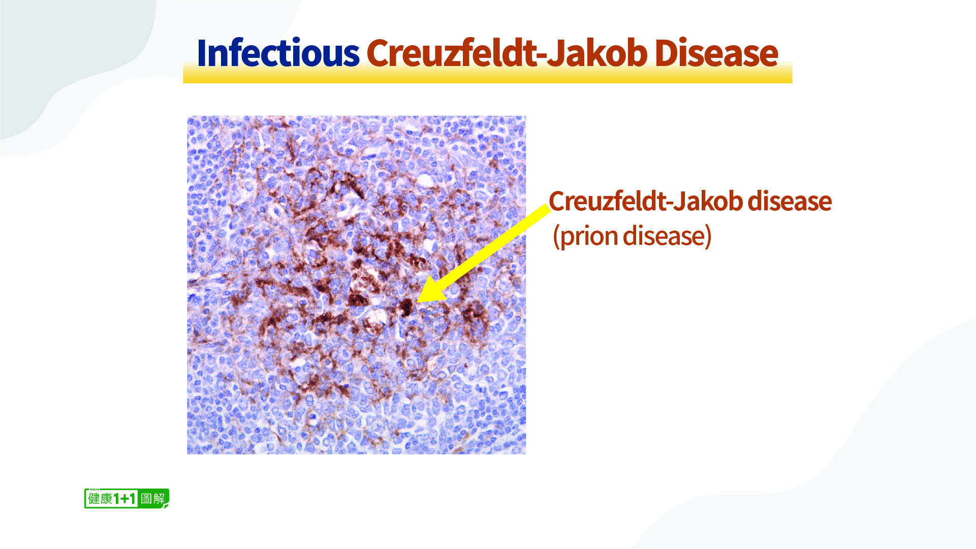 Une maladie cérébrale rare apparaît après la vaccination contre le COVID et son taux de mortalité est étonnamment élevé