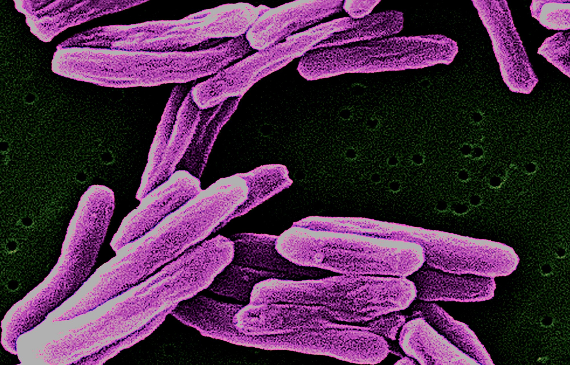 Les avantages surprenants du vaccin contre la tuberculose pour renforcer le système immunitaire