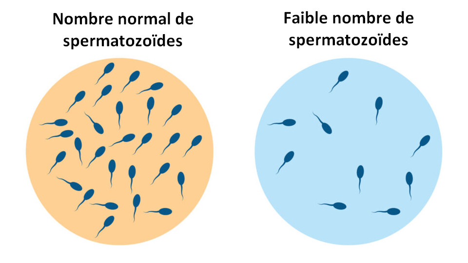 Le taux de spermatozoïdes diminue à un rythme accéléré, selon une nouvelle méta-analyse