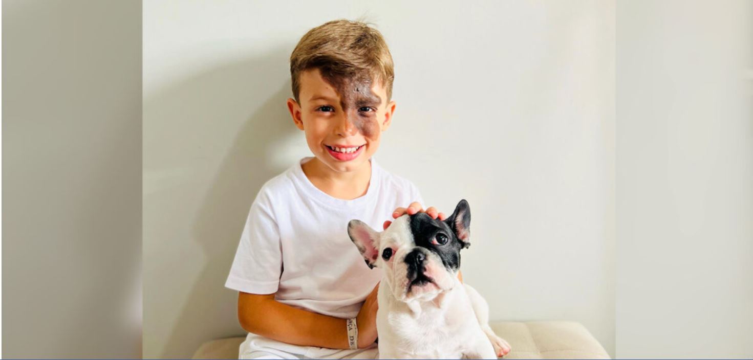 Des parents offrent à leur fils, qui a une tache de naissance unique, un chien qui lui ressemble vraiment