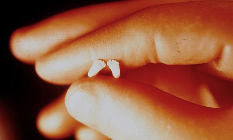 «Pieds précieux»: la photo emblématique d&rsquo;un «fœtus» de 10 semaines prise par un médecin prouve que les bébés avortés ne sont pas des amas de cellules