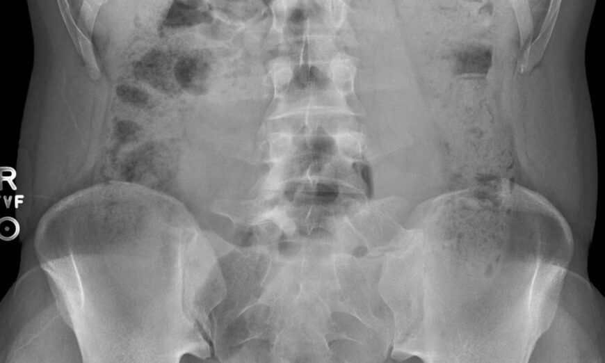 Le cancer du côlon mystérieusement en hausse chez les jeunes Américains, les médecins ne savent pas pourquoi