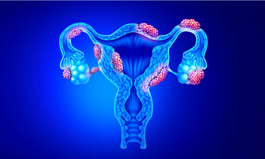 Une cause surprenante de l&rsquo;endométriose, selon une nouvelle étude
