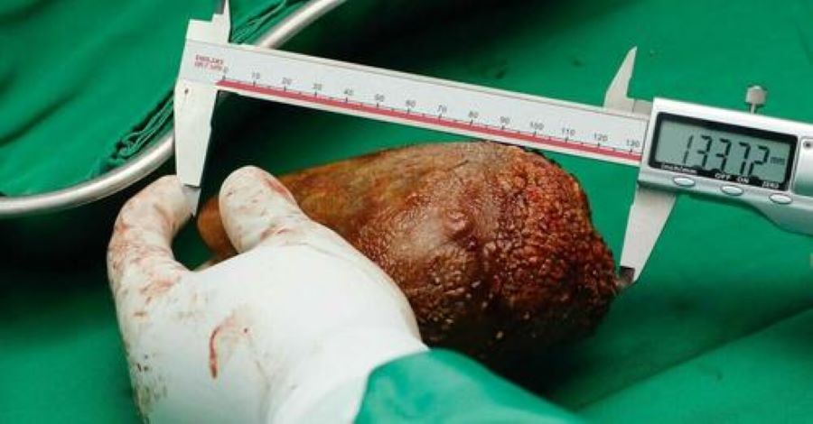 Le plus gros calcul rénal du monde retiré au Sri Lanka, il pèsait 801 grammes