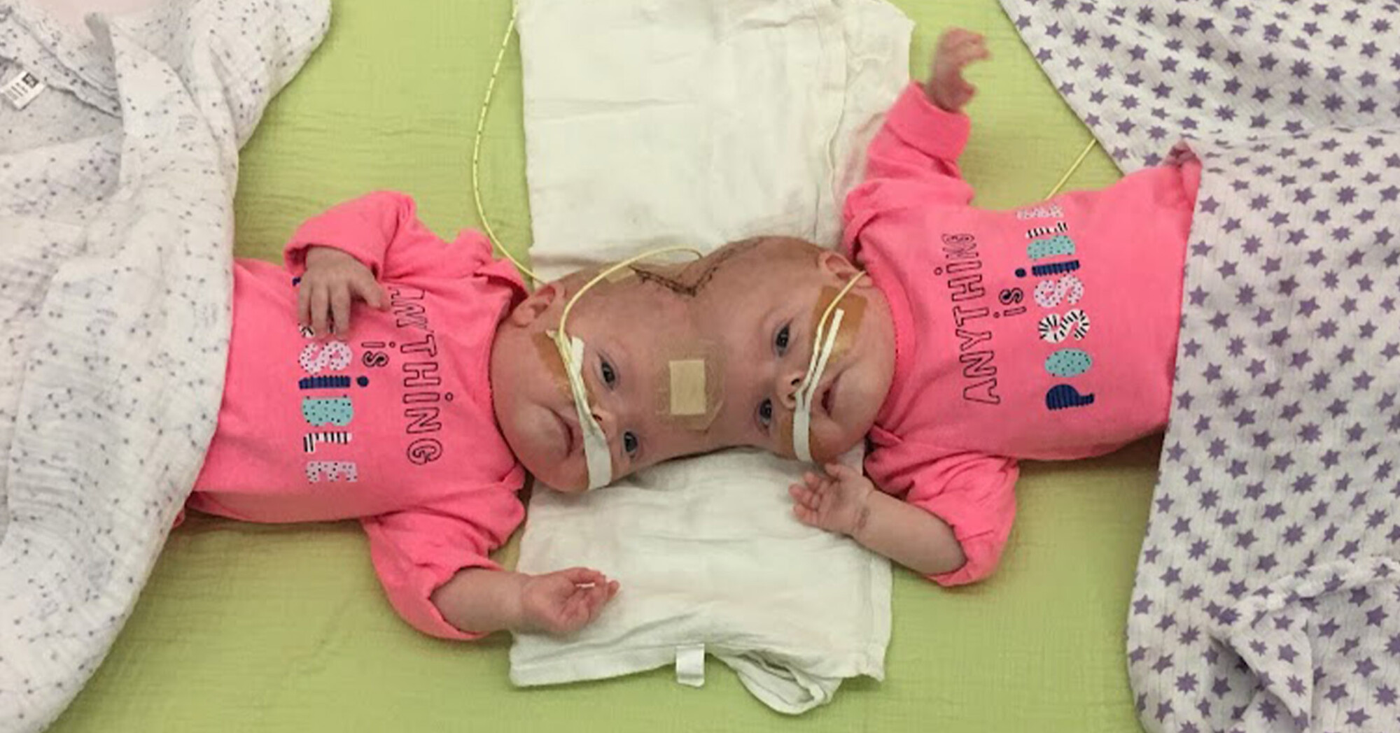 Des jumelles conjointes, qui ont survécu à une opération de séparation, reçoivent leurs diplômes de la maternelle: photos