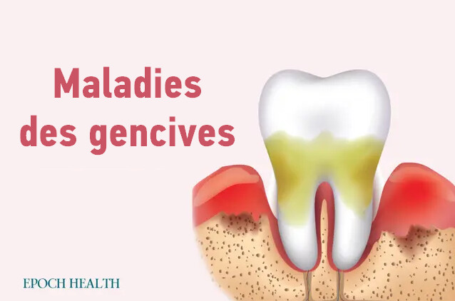 Guide essentiel des maladies des gencives : symptômes, causes, traitements et approches naturelles