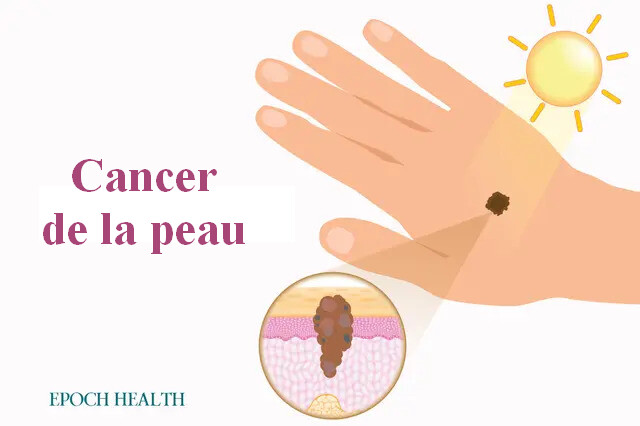 Le guide essentiel du cancer de la peau : symptômes, causes, traitements et approches naturelles