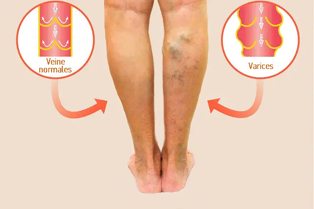 Que faire en cas de varices ? la médecine traditionnelle chinoise a des solutions