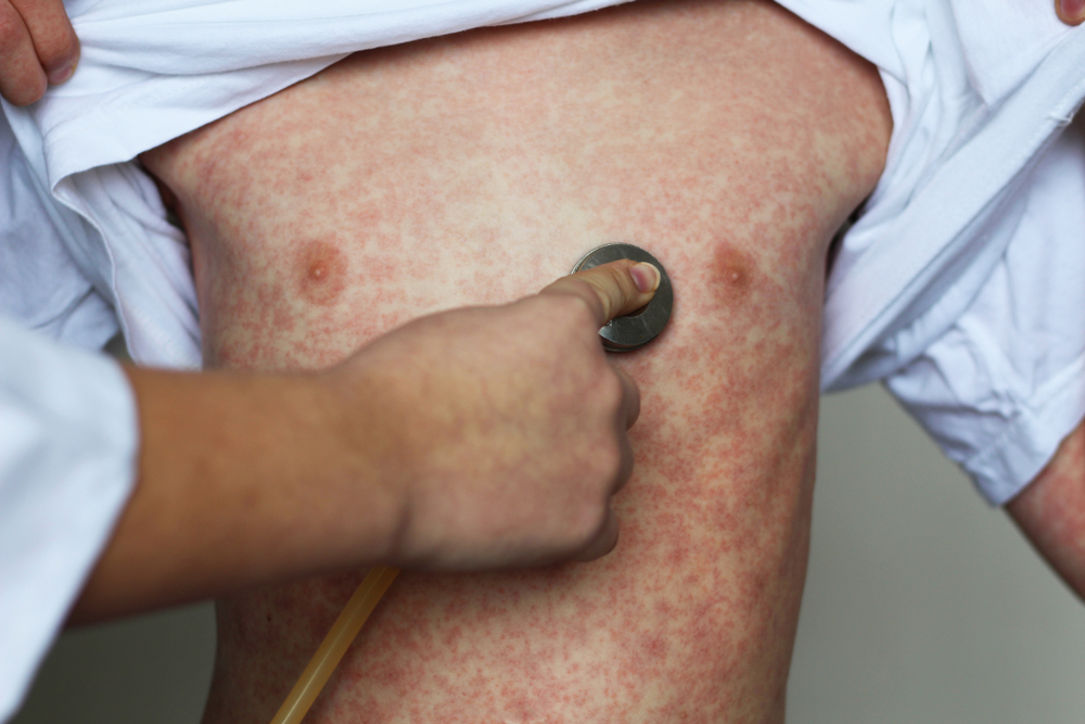 Pourquoi l&rsquo;Ardèche connaît-elle une épidémie de rougeole même si 95% des enfants du département étaient vaccinés ?