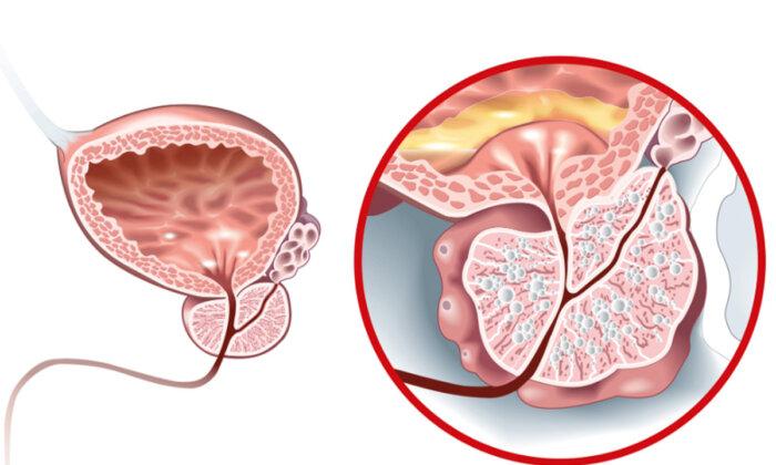 Protégez votre prostate avec ces 7 aliments indispensables