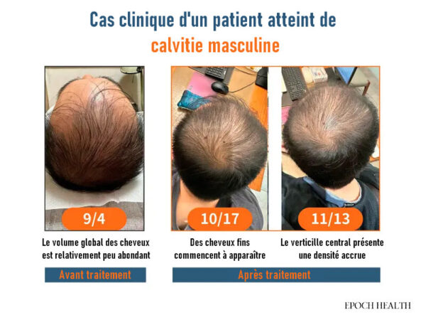 Six conseils pour favoriser des cheveux épais et denses : nutriments essentiels pour une croissance naturelle des cheveux