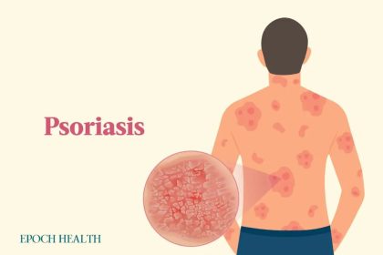 Le guide essentiel du psoriasis : symptômes, causes, traitements et approches naturelles