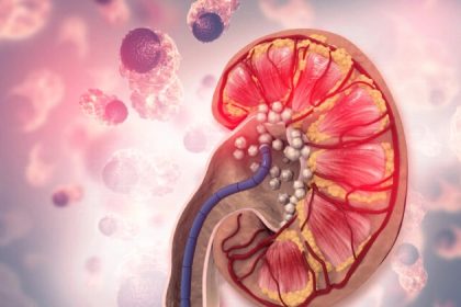 La façon la plus simple d&rsquo;éliminer les calculs rénaux et autres calculs de l&rsquo;organisme