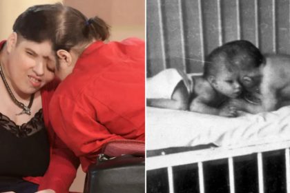 Les jumeaux siamois les plus âgés du monde, Lori et George Schappell, sont décédés à l’âge de 62 ans