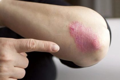 Une mauvaise adaptation au stress serait liée à un risque accru de psoriasis