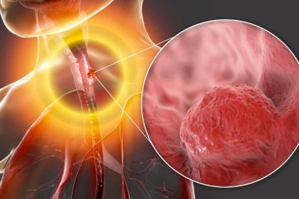 Surveiller les signes précurseurs du cancer de l&rsquo;œsophage