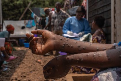 Mpox : l&rsquo;OMS donne son feu vert au premier test de dépistage
