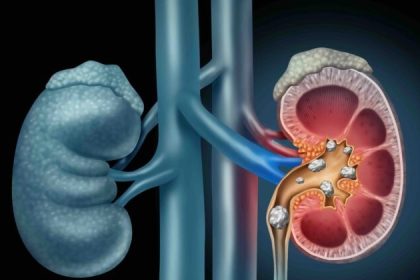 Une bactérie particulière présente dans l&rsquo;urine peut contribuer à la protection contre les calculs rénaux